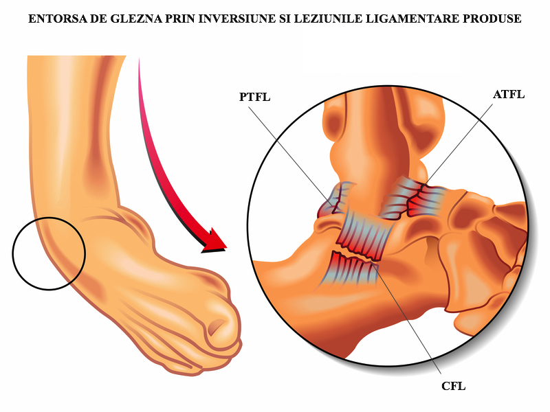 Entorsa de Glezna prin inversiune si leziunile ligamentare produse.
