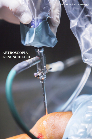 Artroscopia genunchiului (imagine)