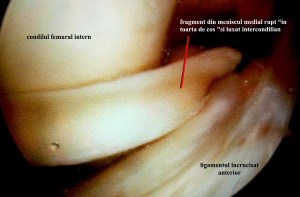 Fragment din meniscul medial rupt “in toarta de cos” si luxat intercondilian