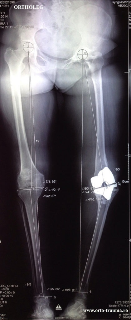 Deteriorarea artroplastiei genunchiului.