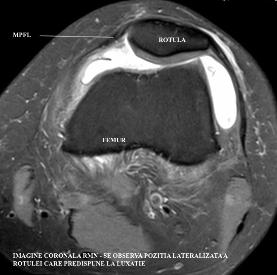 Imagine coronala RMN - Se observa pozitia lateralizata a rotulei care predispune la luxatie.